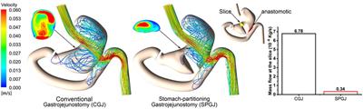 Gastric emptying performance of stomach-partitioning gastrojejunostomy versus conventional gastrojejunostomy for treating gastric outlet obstruction: A retrospective clinical and numerical simulation study